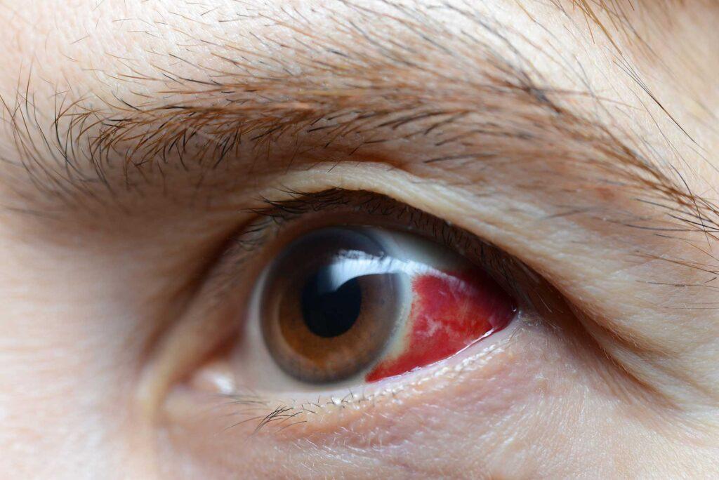 Pterygium Surgery