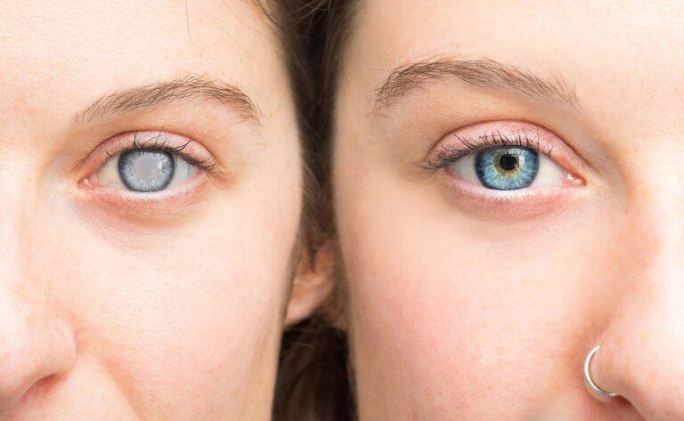 Cataract