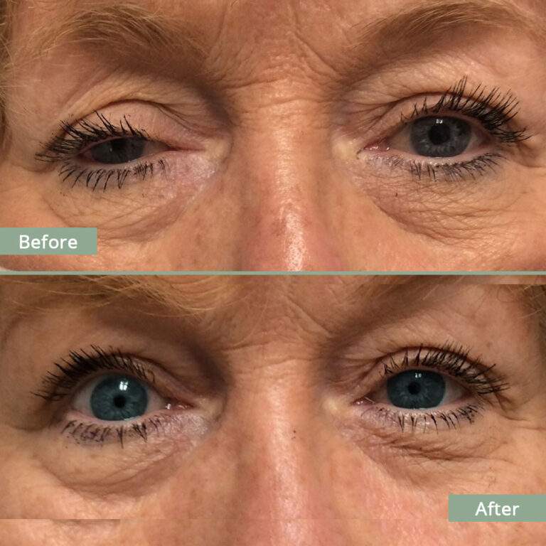 Before/After Image of a woman that underwent corrective eyelid surgery