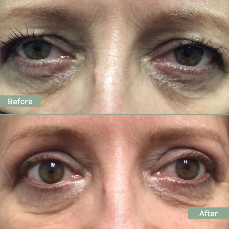 Before/After Image of a woman that underwent corrective eyelid surgery