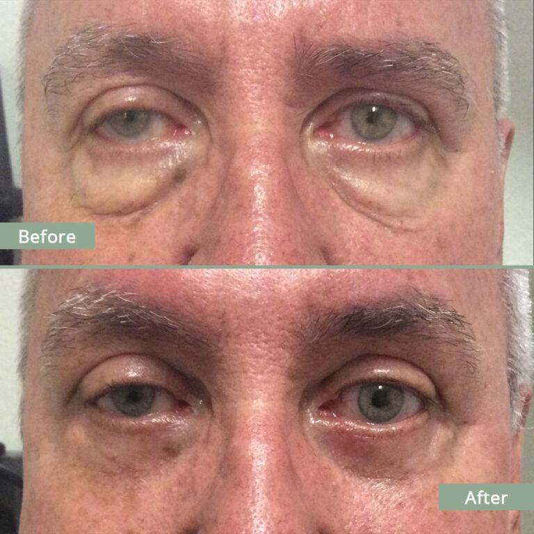 Before/After Image of a man that underwent corrective eyelid surgery