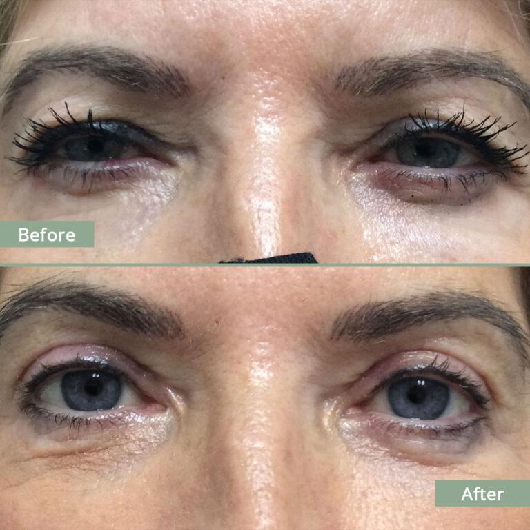 Before/After Image of a woman that underwent corrective eyelid surgery