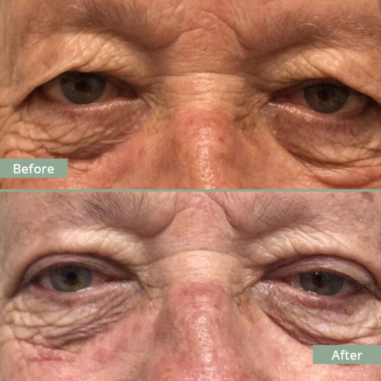 Before/After Image of a man that underwent corrective eyelid surgery
