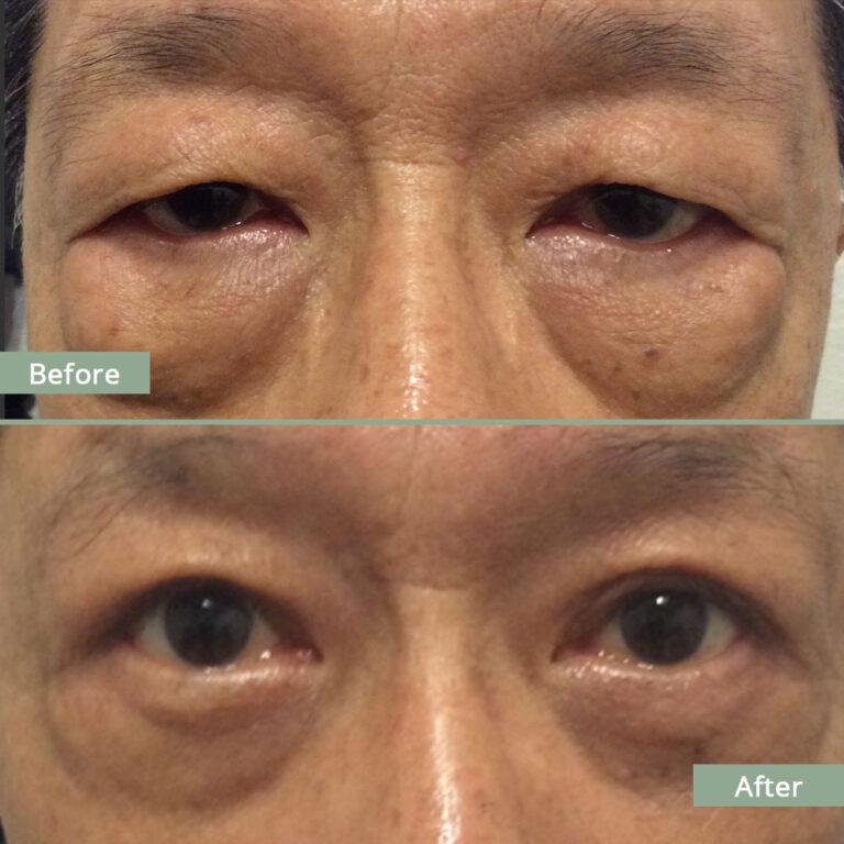 Before/After Image of a man that underwent corrective eyelid surgery