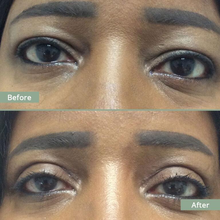 Before/After Image of a woman that underwent corrective eyelid surgery