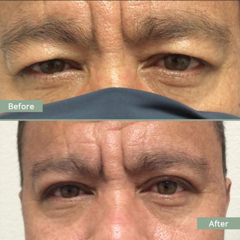 Before/After Image of a man that underwent corrective eyelid surgery