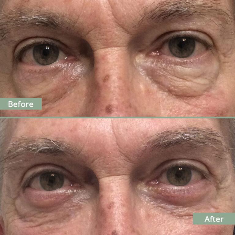 Before/After Image of a man that underwent corrective eyelid surgery
