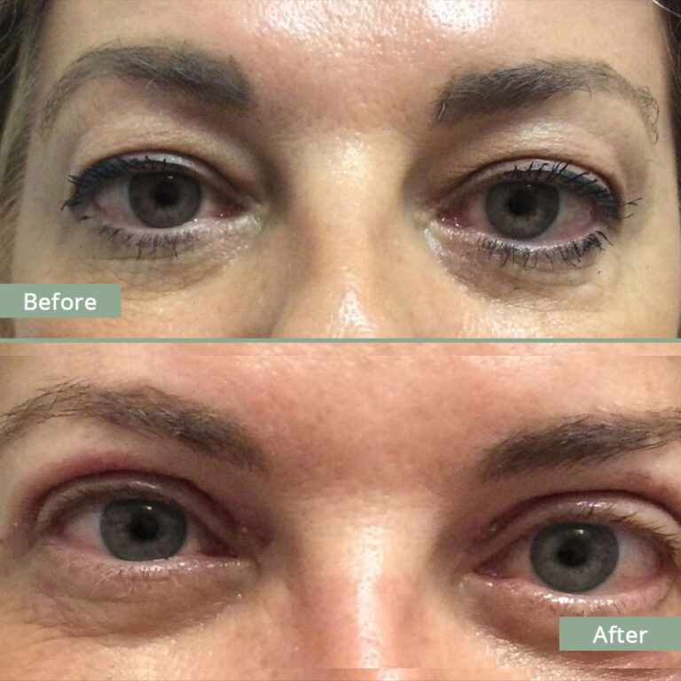 Before/After Image of a woman that underwent corrective eyelid surgery