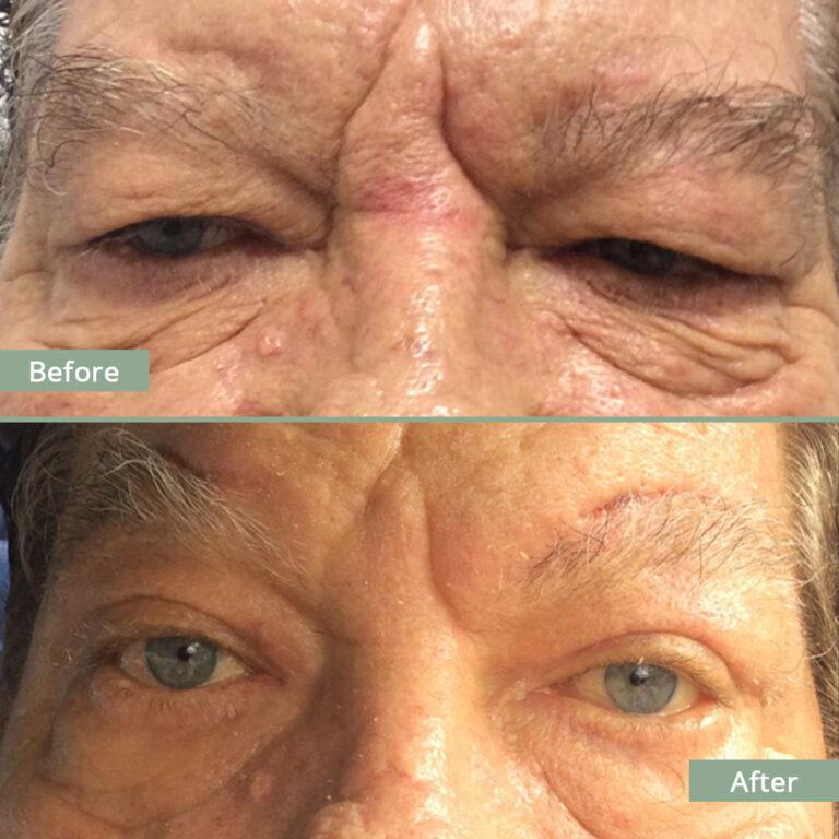Before/After Image of a man that underwent corrective eyelid surgery