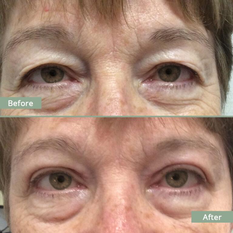 Before/After Image of a woman that underwent corrective eyelid surgery