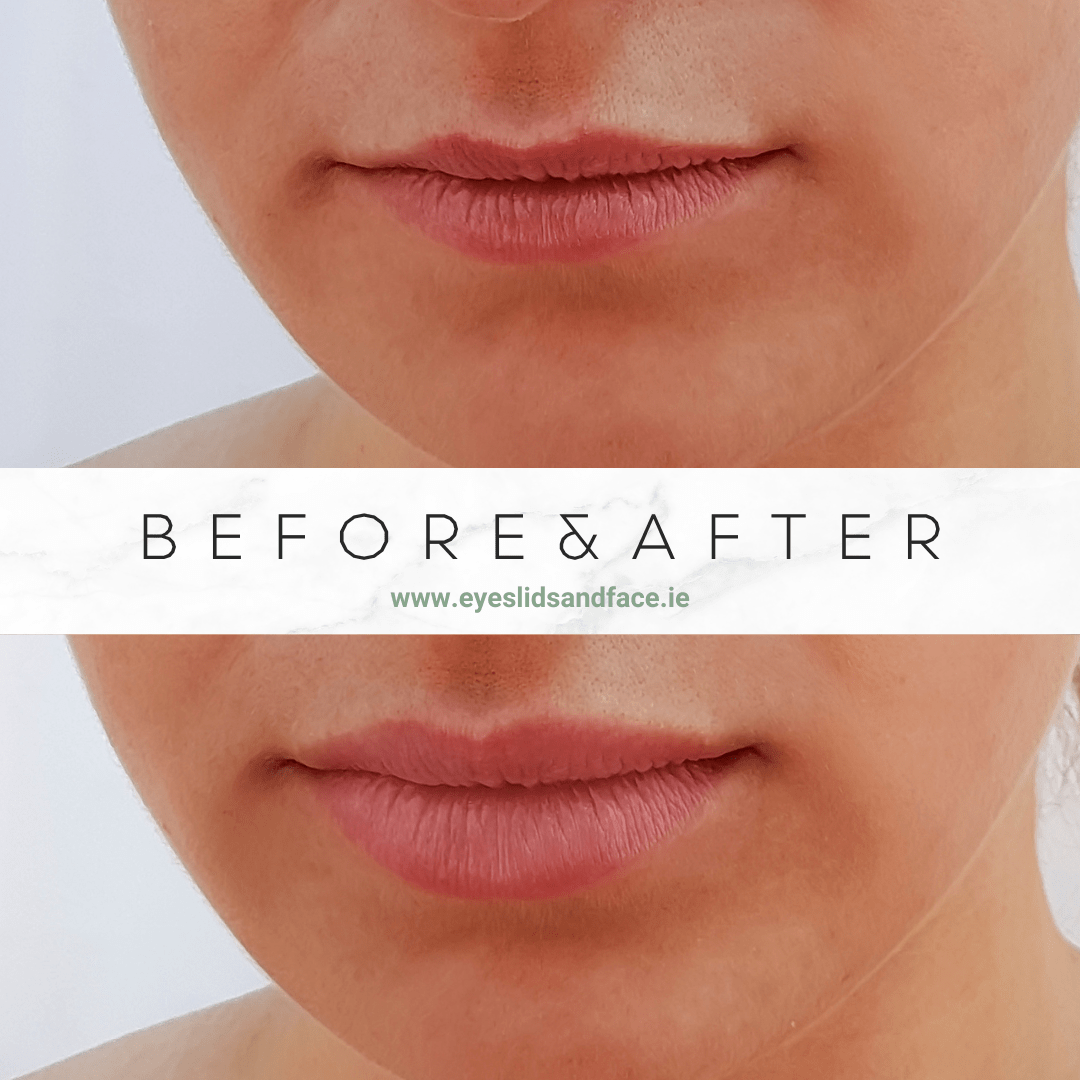 Before/After Image of a woman that underwent lip filler treatment