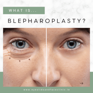 Graphic that says :What is blepharoplasty?