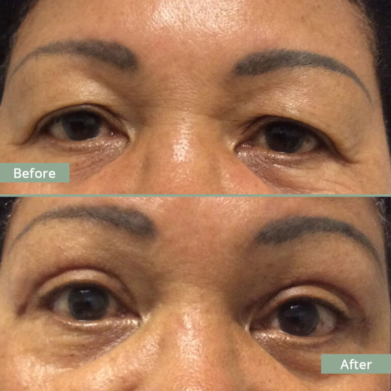 Before/After Image of a woman that underwent corrective eyelid surgery