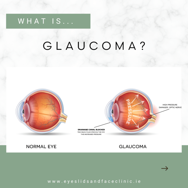 Graphic with the text: 'what is glaucoma?'