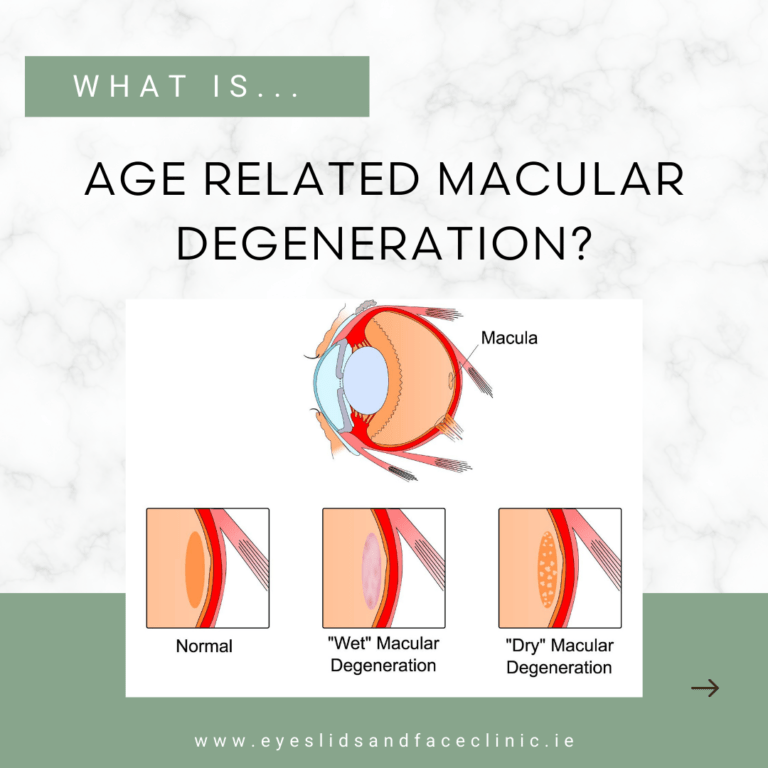 Graph that says: What is age related macular degeneration?