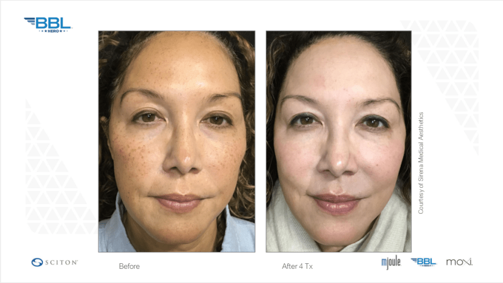 Woman showing results of her face before and after a BBL treatment