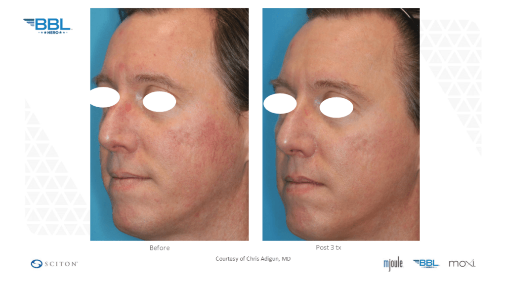 Man showing results of his face before and after a BBL treatment