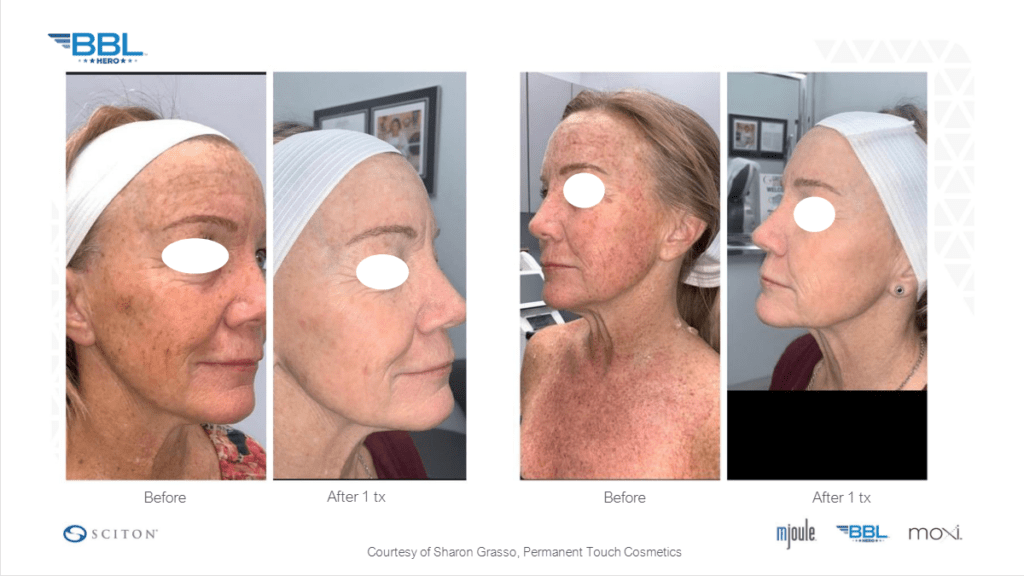Woman showing results of her face before and after a BBL treatment