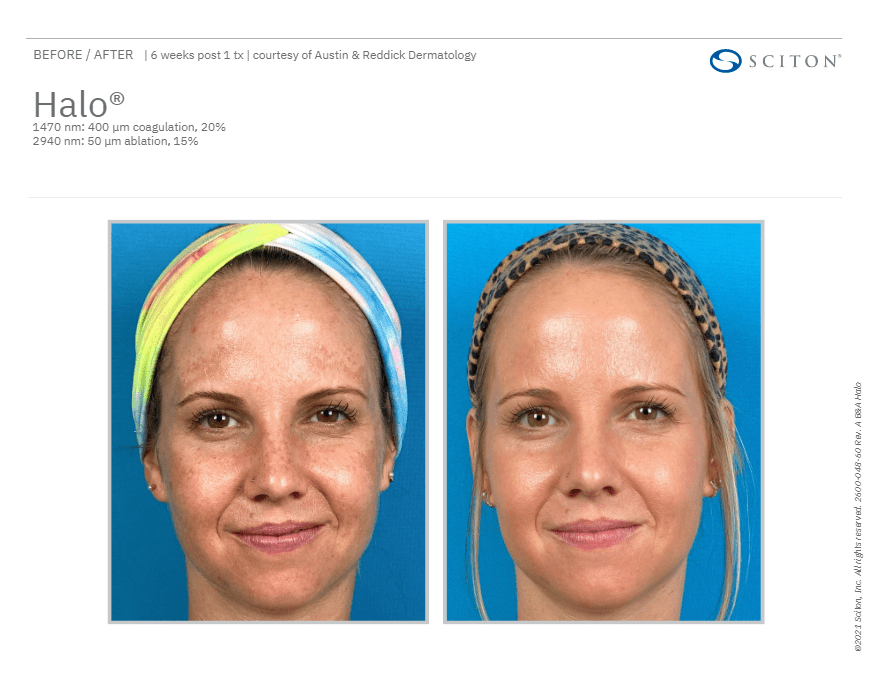 Sciton Halo Laser Treatment Eyes, Lids & Face Clinic