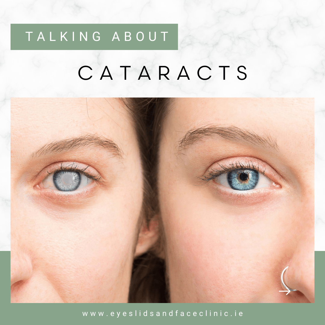 Cataracts graphic side by side