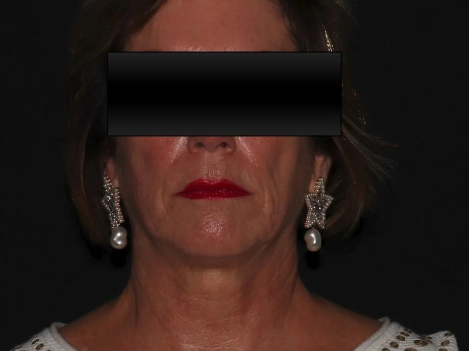 Face after BBL Laser Treatment