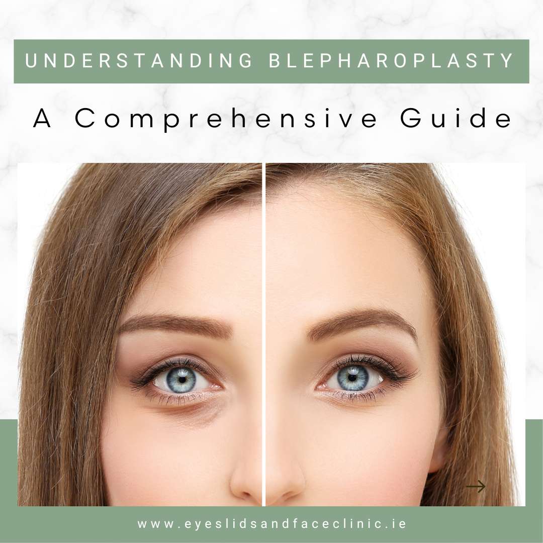 Understanding Blepharoplasty