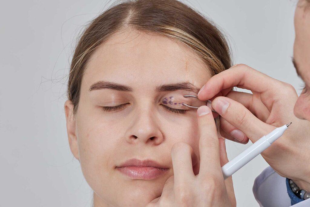 blepharoplasty-eyes-lids-face-ennis-dr-maeve
