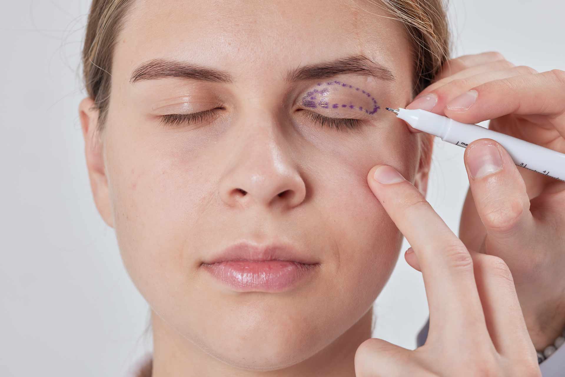 drmaeve-blepharoplasty-skinlaser-ennis-ireland
