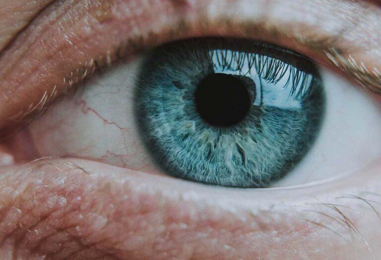 Blepharoplasty-Eyelid-Surgery-Galway-Dr-Maeve-ODoherty