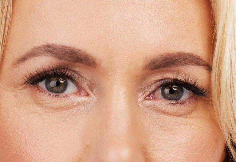 Blepharoplasty-Eyelid-Surgery-ennis-Dr-Maeve-ODoherty-Recovered