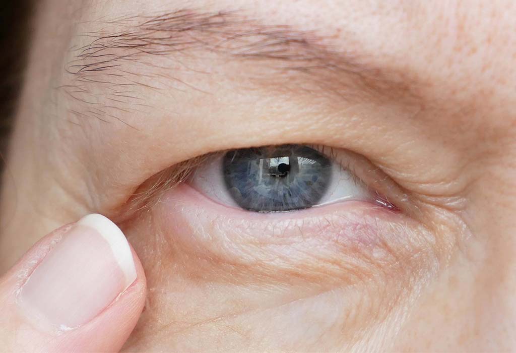 Droopy-eyelid-Blepharoplasty-Eyelid-Surgery-Galway-Dr-Maeve-ODoherty