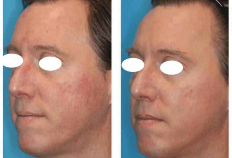 bbl-laserBlepharoplasty-Eyelid-Surgery-Galway-Dr-Maeve-ODoherty