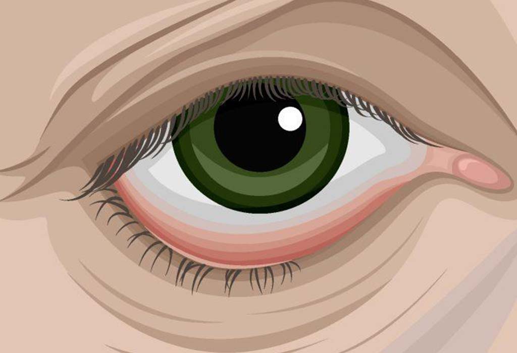 ectropion-Blepharoplasty-Eyelid-Surgery-Galway-Dr-Maeve-ODoherty