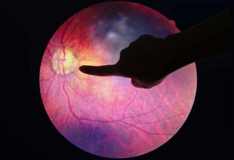 eye-screening-Blepharoplasty-Eyelid-Surgery-Galway-Dr-Maeve-ODoherty