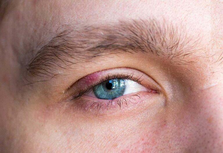 stye-Blepharoplasty-Eyelid-Surgery-Galway-Dr-Maeve-ODoherty