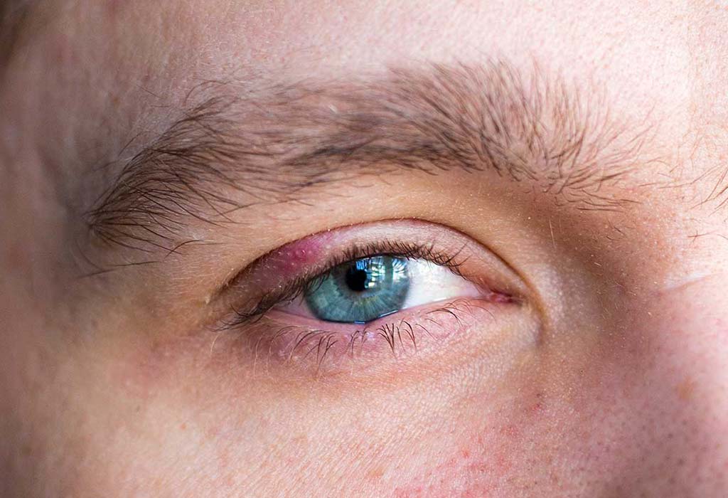 stye-Blepharoplasty-Eyelid-Surgery-Galway-Dr-Maeve-ODoherty