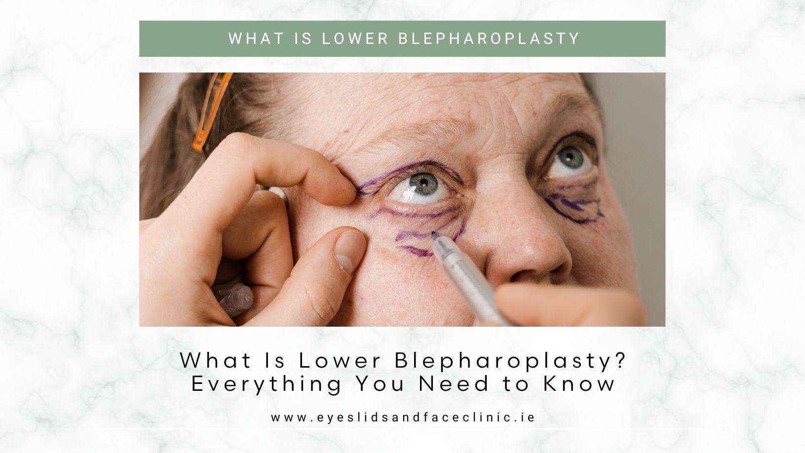 lower blepharoplasty